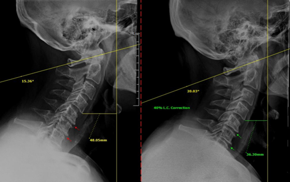 Patient X-Ray Progression