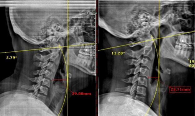 Patient X-Ray progress over 2 months of care