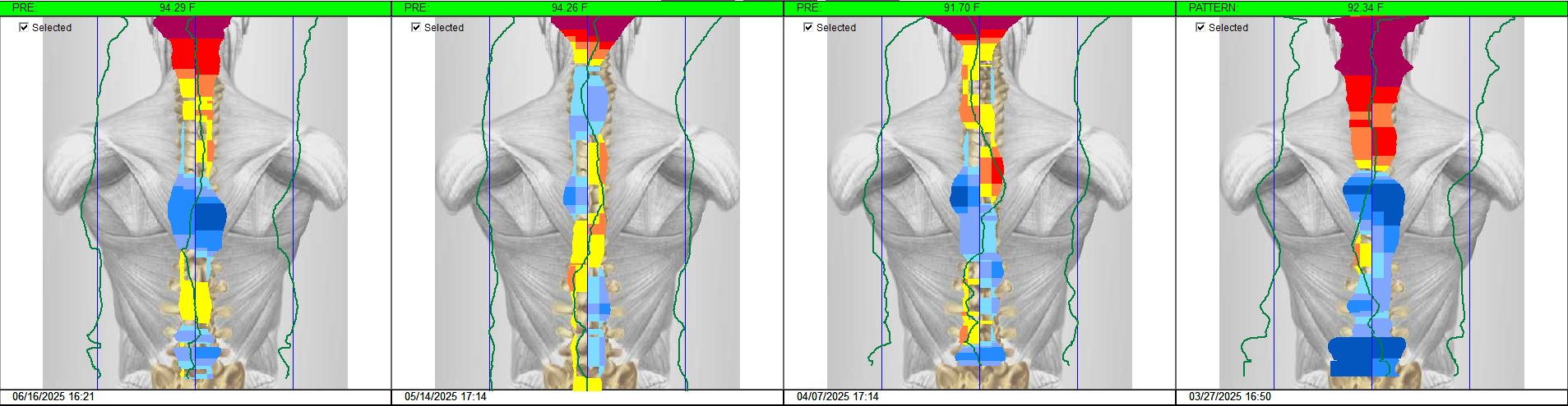 Thermal scan of patient before and after adjustment for specific symptom